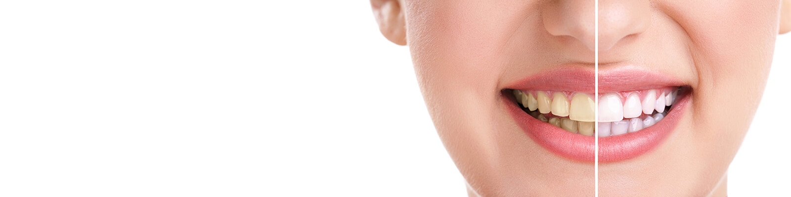 Teeth Whitening